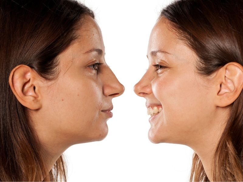 Sivas'ta Burun Estetiği: Yöntemler ve Süreç 1 Sivas'ta Burun Estetiği: Yöntemler ve Süreç