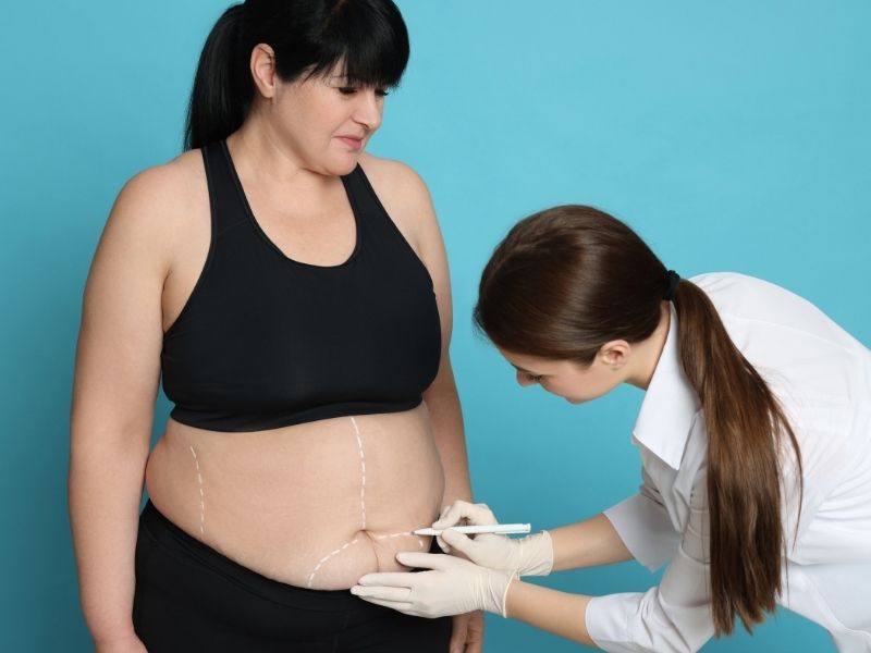 Estetik Cerrahide Popüler Seçenekler: Bişektomi, Karın Germe ve Liposuction